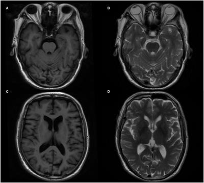 Case Report: Coexistence of Anti-AMPA Receptor Encephalitis and Positive Biomarkers of Alzheimer's Disease